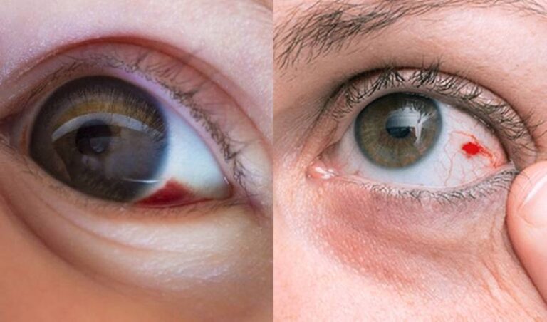Seus olhos ficam assim? Isso revela algumas informações importantes para a sua saúde.