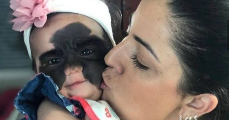 Menina que nasceu com ‘máscara do Batman’ passa por cinco cirurgias e fica ‘linda como uma princesa’
