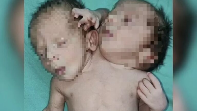 Bebê nasce com duas cabeças, três mãos e dois corações; veja fotos