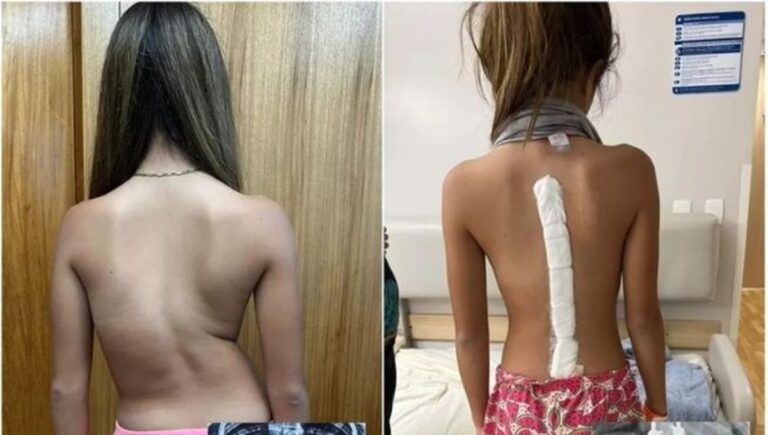 Milagre: Menina com ‘coluna em S’ dá primeiros passos depois da cirurgia