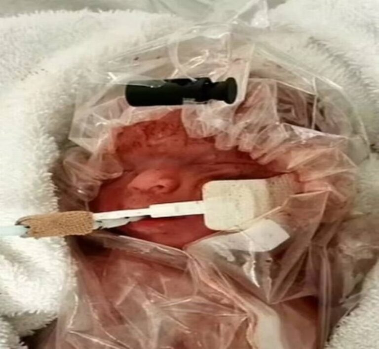 Mãe relata como médicos salvaram seu bebê prematuro ao colocá-lo em um saco plástico