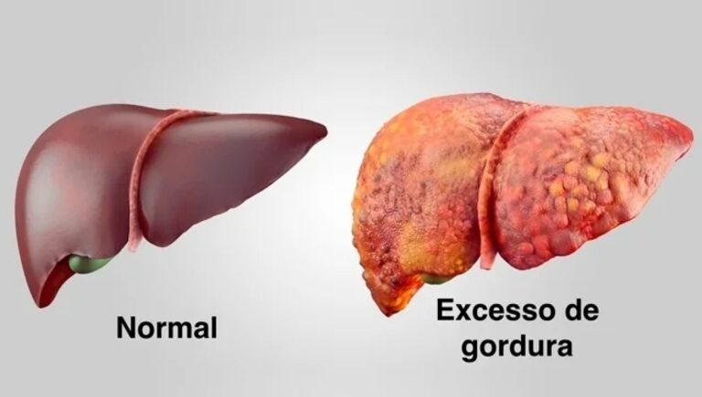Atenção para esses 11 sinais de que está com fígado gordo