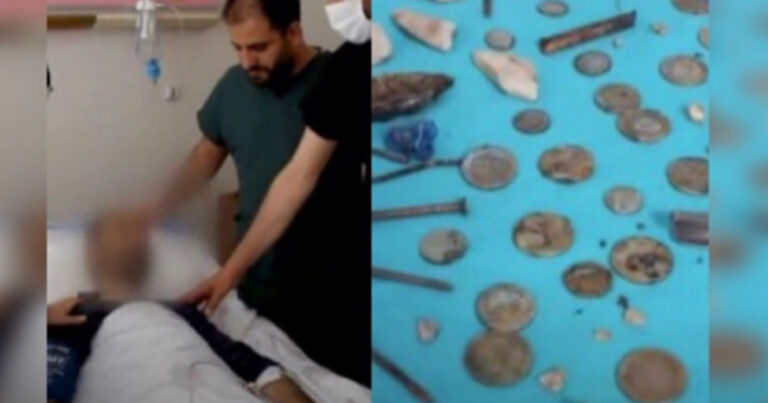 Cacos de vidro, imãs, baterias: Homem é internado e passa por cirurgia para retirar 233 objetos de seu estômago