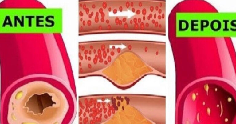 Com essa receita caseira você vai limpar as artérias do coração e prevenir o infarto e ataque cardíaco