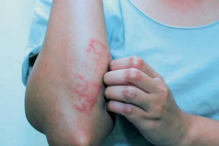 Alerta de diabetes: Confira 6 sinais na pele que podem indicar a doença