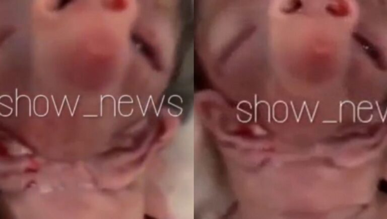 Mãe tem bebê em clínica e criança nasce com ‘focinho de porco’ e com as orelhas no pescoço