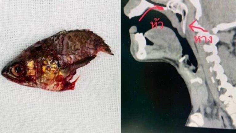 Peixe pula direto para a boca de pescador e fica preso entre a garganta e a cavidade nasal