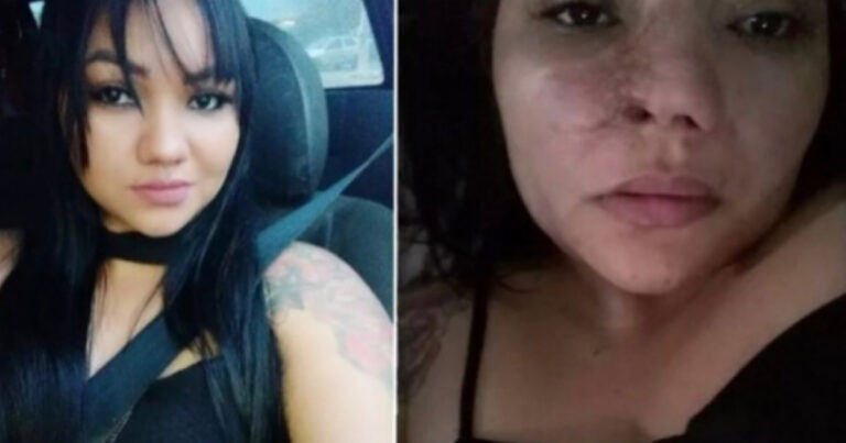 Mulher processa dentista por ter perdido parte do nariz; profissional se defende e diz que prestou assistência