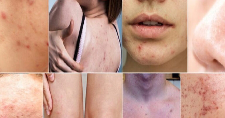 Você tem acne em uma dessas 8 partes do corpo? Então saiba disso urgentemente