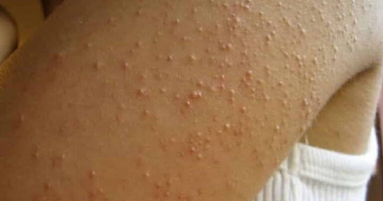Aparecem essas bolinhas em seu braço? Então você precisa saber disso urgentemente