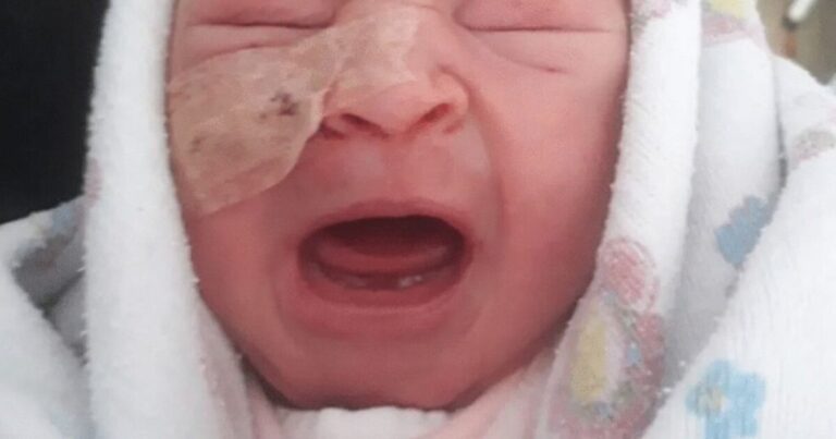 Bebê tem rosto cortado ao passar por cesárea e pai faz duro desabafo: ‘Dói’