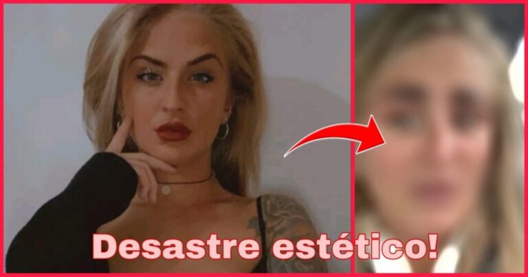 Vídeo: Mulher faz procedimento estético desastroso e o resultado deixou todos pasmos; ‘Horrível’