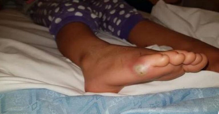 Pais alertam após filha de 4 anos quase perder a vida após pegar bactéria por algo que muitas pessoas fazem