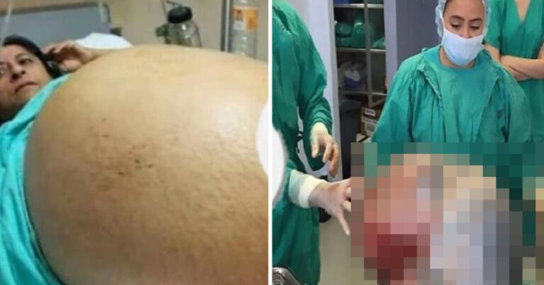 Você se surpreenderá ao descobrir o que morava na barriga desta mulher