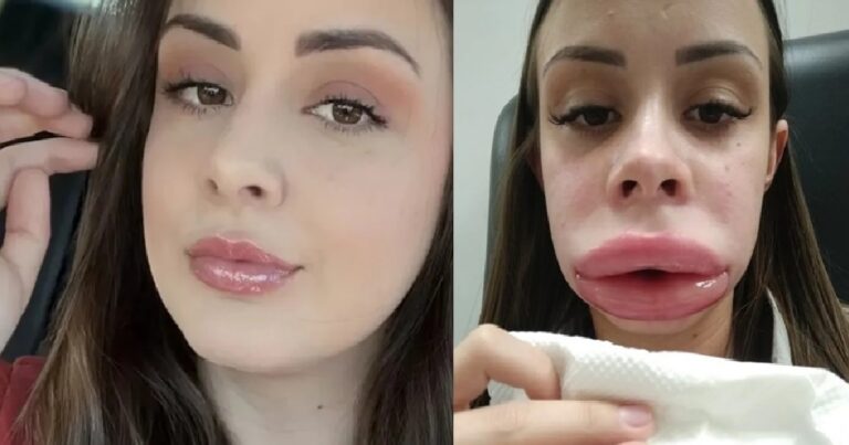 Jovem descobre doença rara ao ficar com rosto muito inchado após preenchimento labial