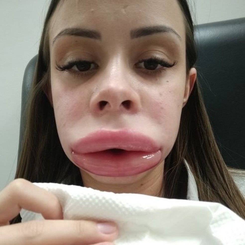 Ap&oacute;s preenchimento labial, Pamela Andrade teve forte incha&ccedil;o na boca, no rosto, nos olhos &mdash; Foto: ARQUIVO PESSOAL/BBC