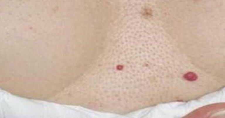 Pontinhos vermelhos no corpo: é melhor você saber disso se você tenha um desses pontos
