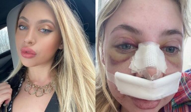 Por causa de cirurgia plástica, modelo descobre pedaço de cocaína preso no nariz