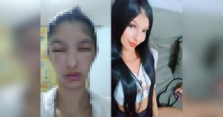 Jovem de BH fica com o rosto deformado após usar tinta para cabelo: ‘Um monstro’