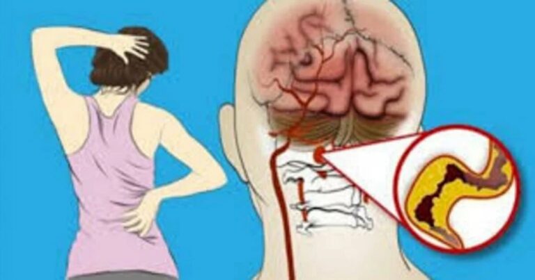 Esses são os sinais que o corpo dá quando vai sofrer um AVC e nunca devem ser ignorados