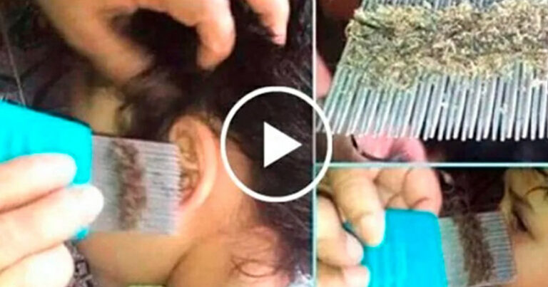 A Menina Chora De Dor Na Cabeça, Quando a Mãe Olha O Cabelo Dela Ela Ligou Para a Polícia