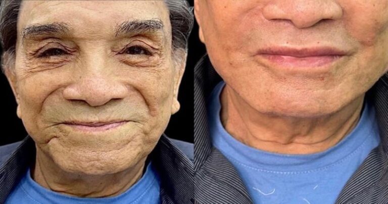 Aos 86 anos, Dedé Santana divide opiniões ao mostrar resultado de harmonização facial: ‘Boneco de borracha’