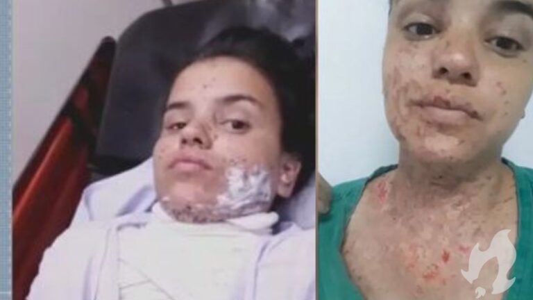 Jovem tem parte do corpo queimado e causa do acidente espanta a polícia quando chega no local