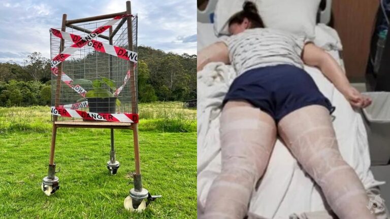 Por encostar em árvore venenosa, australiana sofre com dores insuportáveis há nove meses: ” Pior que dor de parto”