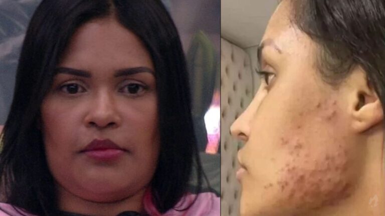 Cantora Flay comenta reações após o uso do famoso ”chip da beleza”: ‘Foi com o chip que ganhei 10 kg’