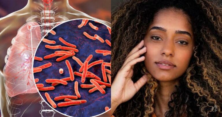 Entenda perigos e sintomas da Tuberculose, doença que tirou a vida de atriz aos 22 anos