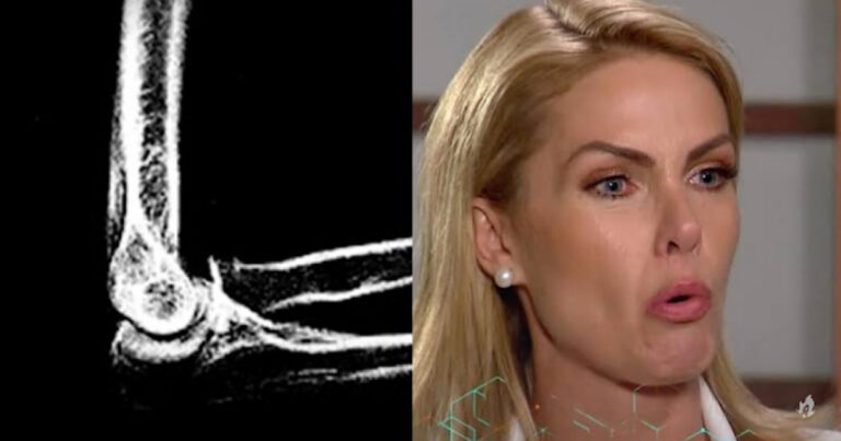 Caso Ana Hickmann: laudo médico detalha agressão sofrida pela apresentadora