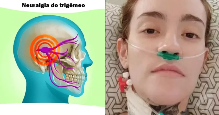 Desistiu de viver? Neuralgia do trigêmeo, doença da influenciadora, pior dor do mundo