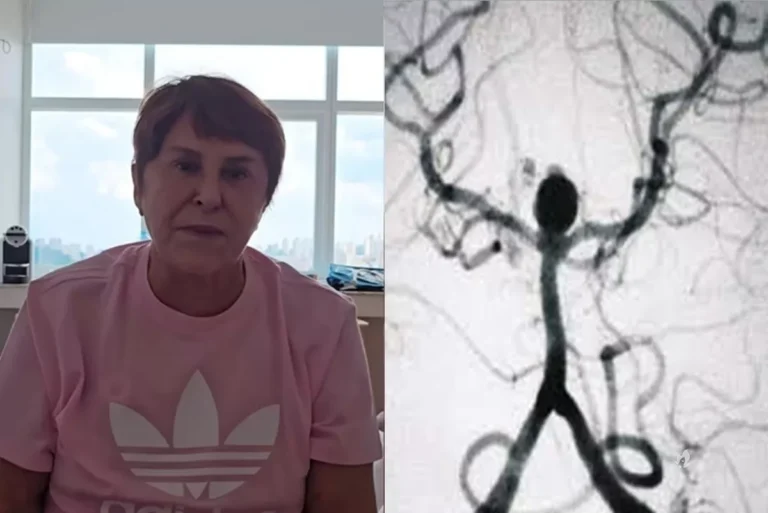Aneurisma: Tome conhecimento do quadro que fez Márcia Sensitiva passar por cirurgia