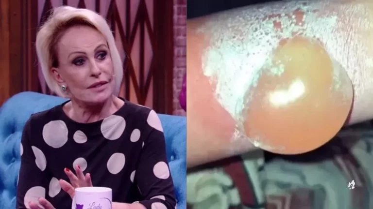 Ana Maria Braga assusta ao mostrar bolha provocada em acidente doméstico: ‘Ninguém tá livre’