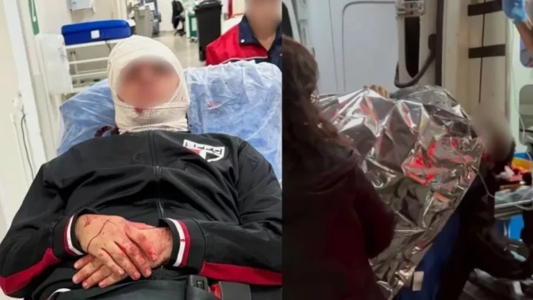 Vítimas de queda de placa no Morumbis passam por cirurgia na cabeça em SP