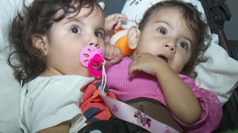 Siamesas de São Paulo unidas pelo abdômen e bacia são internadas para cirurgia de separação em Goiânia
