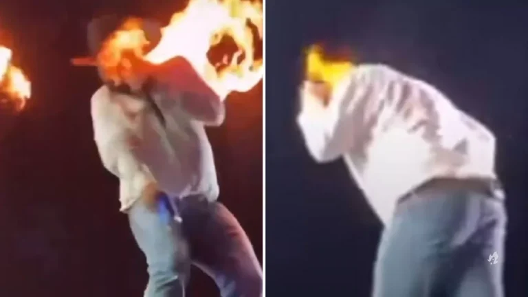 Cantor sertanejo Léo mostra como ficou seu rosto após sofrer queimaduras durante acidente em show