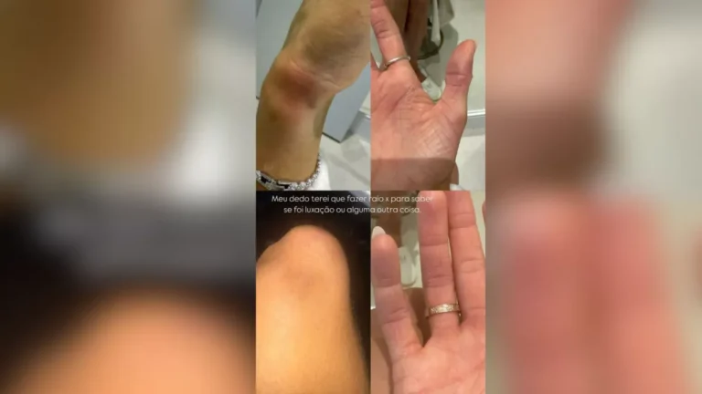 Ex-namorada acusa MC Brisola de agressão e mostra lesões na internet
