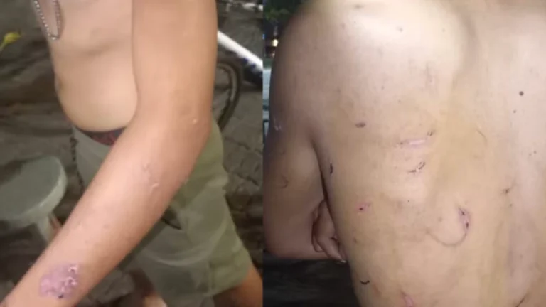 BRUTAL! Jovem é torturado pela melhor amiga: Me agredia com caco de vidro, ferro quente, faca