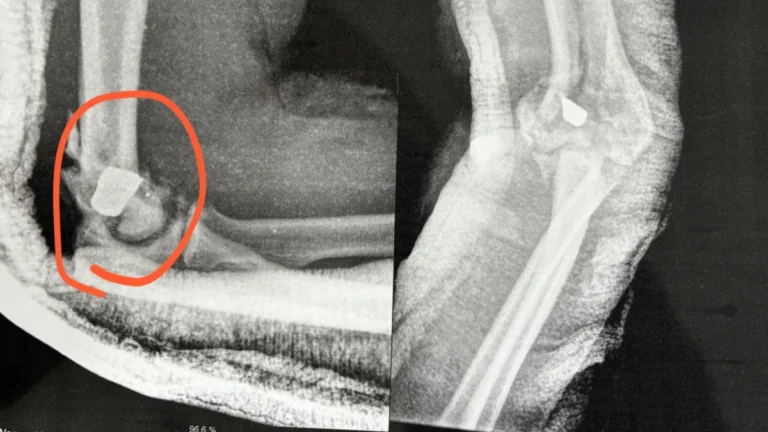 Cantor gospel está com bala no braço e fará cirurgia de risco; veja raio-X