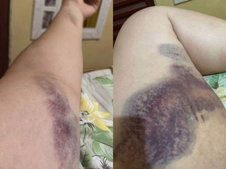 Foi queda livre, diz mulher que caiu de assento de roda-gigante em parque no AC