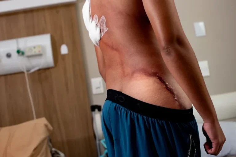Raio em ato de Nikolas: jovem que teve as costas rasgadas recebe alta