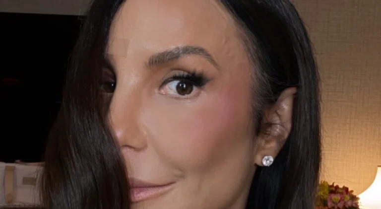 Ivete Sangalo mostra hematomas após acidente: “Só bora”