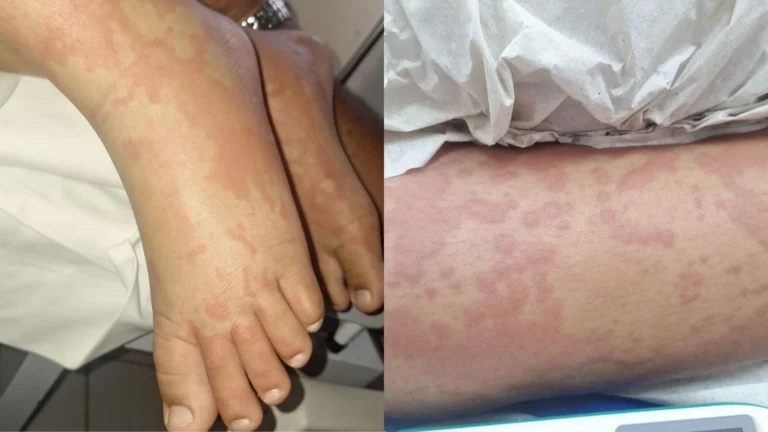 Criança internada no RN teve manchas após uso de detergente, diz tio