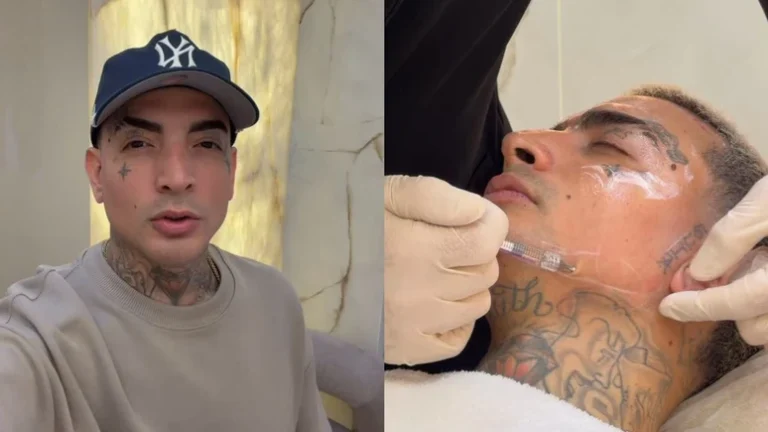 MC Guimê mostra resultado de manutenção da harmonização facial; veja o antes e depois