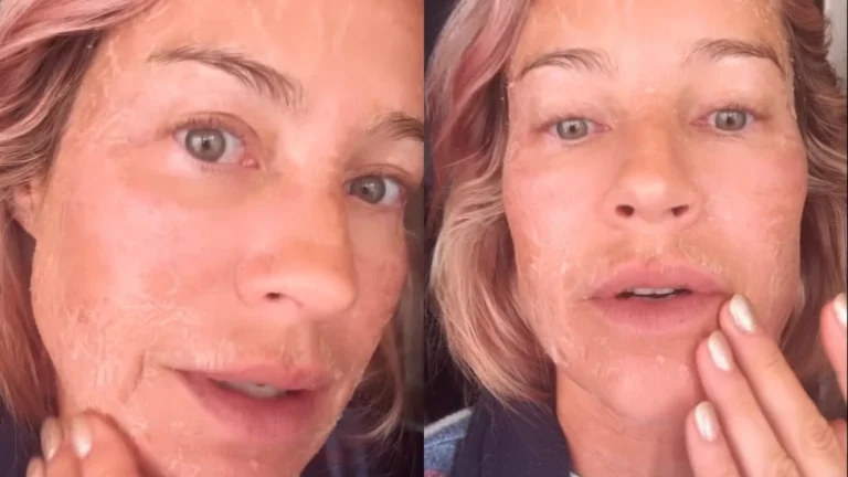 Luana Piovani explica descamação no rosto: “Fazendo 50 com cara de 100”