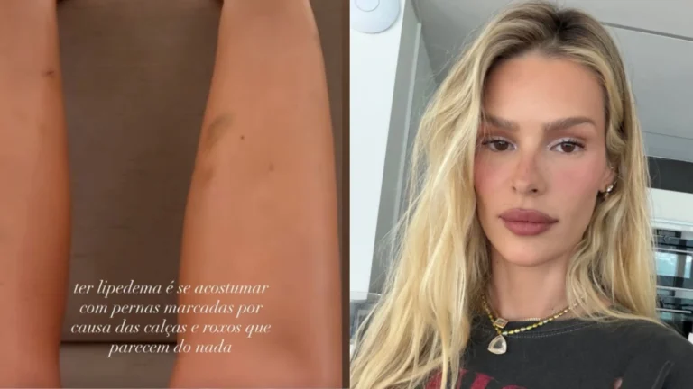 “Roxos aparecem do nada”: Yasmin Brunet mostra hematomas; entenda lipedema